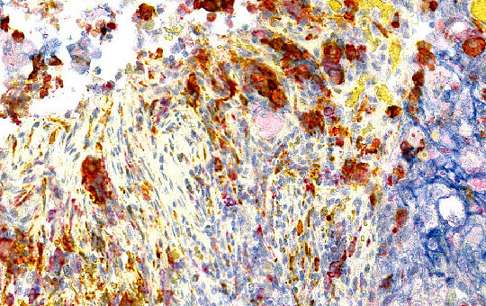 Lung Adenocarcinoma: CD163, CD68, PD-L1 10x
